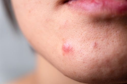 What Is Under Boob Acne? (Causes, Treatments, and More)