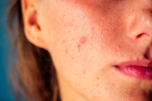 Does Touching Your Face Cause Acne?