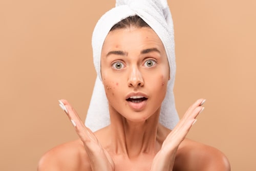 Acne Skin Treatment Blog by Exposed Skin Care Page 4