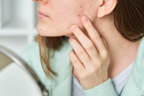 how-to-make-acne-go-away-fast-must-know-tips-and-tricks